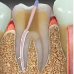 Sybron Endo Sealapex Root Canal Sealer